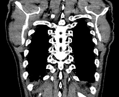 Compilation of Chest CT Scans - Thorax CTs - embodi3D.com