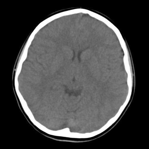 Brain 1 - Skull, Head, and Neck CTs - embodi3D.com