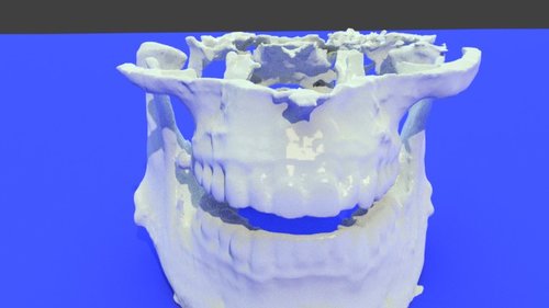 bone model - stl file processed - Dental, Orthodontic, Maxillofacial ...