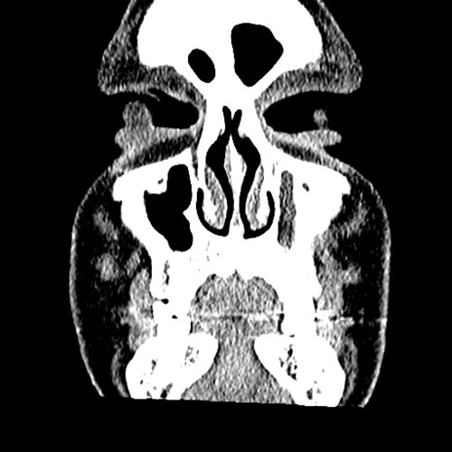 Chronic sinusitis Dental, Orthodontic, Maxillofacial CTs