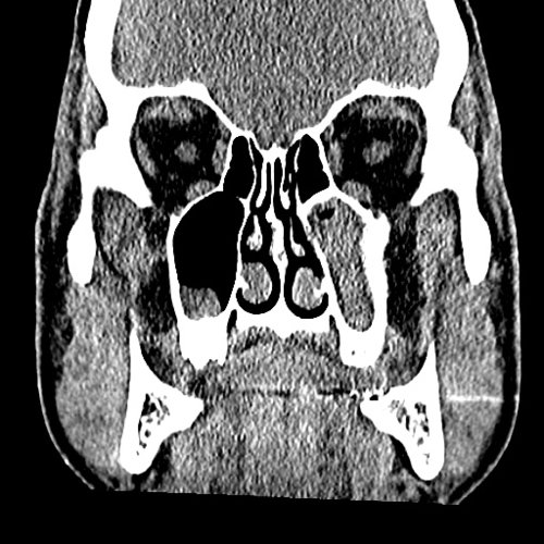 Chronic sinusitis Dental, Orthodontic, Maxillofacial CTs