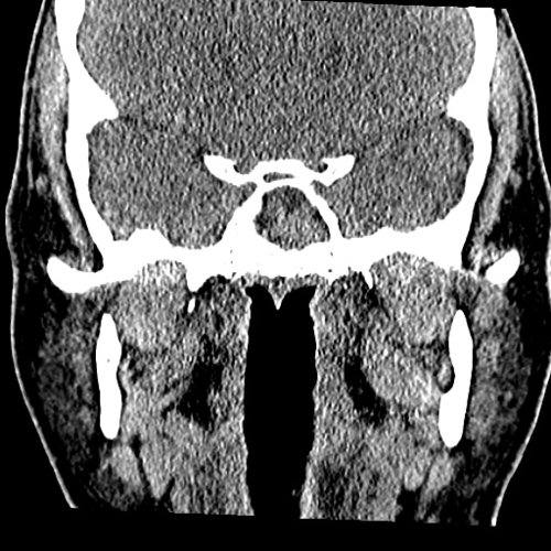 Chronic sinusitis Dental, Orthodontic, Maxillofacial CTs