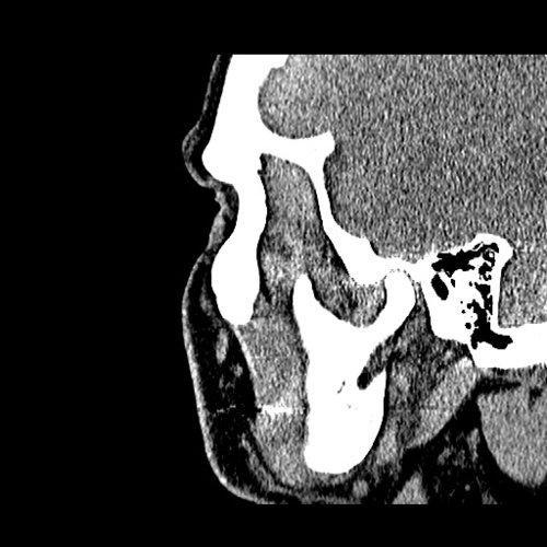 Chronic sinusitis Dental, Orthodontic, Maxillofacial CTs