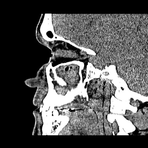Chronic sinusitis Dental, Orthodontic, Maxillofacial CTs