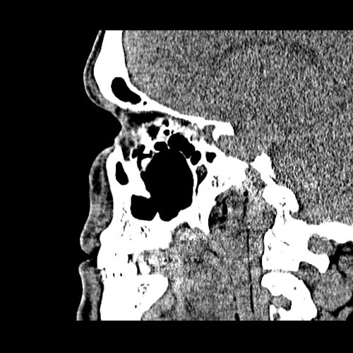 Chronic sinusitis Dental, Orthodontic, Maxillofacial CTs