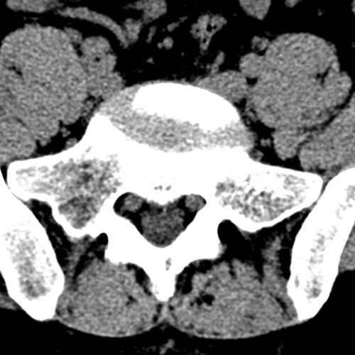 LWS - Spine CTs - embodi3D.com