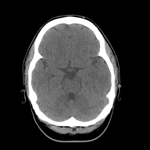 brain - Skull, Head, and Neck CTs - embodi3D.com