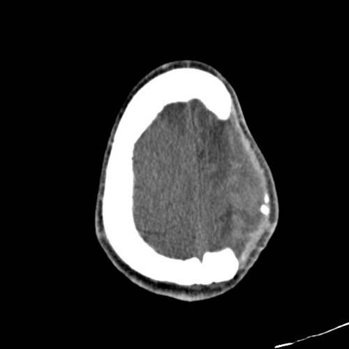 vgs - Skull, Head, and Neck CTs - embodi3D.com