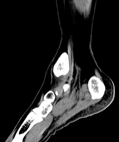Pilon - Lower Extremity CTs - embodi3D.com