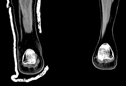 Pilon - Lower Extremity CTs - embodi3D.com