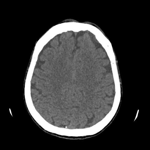 Head - NRRD - Skull, Head, and Neck CTs - embodi3D.com