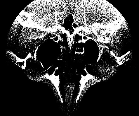 Meyer Kieferscan - Skull and Face - embodi3D.com