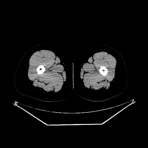 ct legs edited - Lower Extremity CTs - embodi3D.com