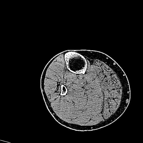 Tib-Fib high res - democratiz3D® Processing - embodi3D.com