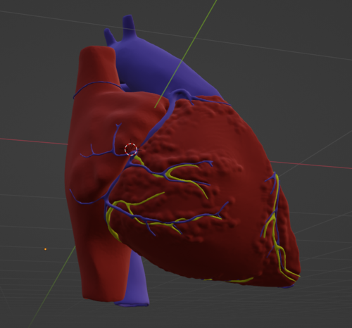 3d model of heart with transposition of the great arteries, long axis ...