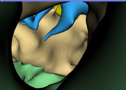 Temporal bone with all inner ear structures reconstructed from CT scan ...