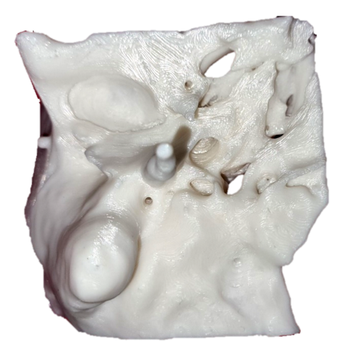 Temporal bone with all inner ear structures reconstructed from CT scan ...