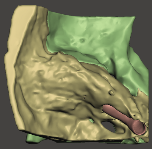 Temporal bone with all inner ear structures reconstructed from CT scan ...