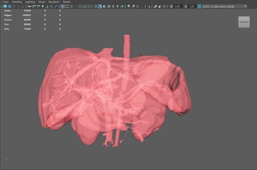 3D Model of Pre- and Post- Operative Liver - Liver - embodi3D.com