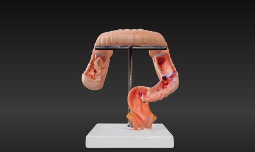3D Model of Intestinal Diseases - Other organs - embodi3D.com