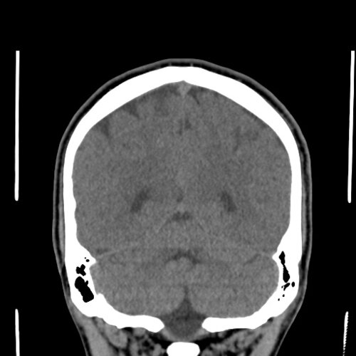 Guillaume Van Rijckeghem - Schedel CT - Skull, Head, and Neck CTs ...