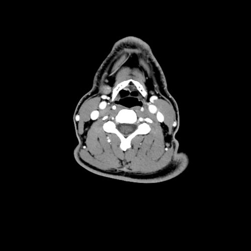 Neck CTV Bone and Vascular - Skull, Head, and Neck CTs - embodi3D.com