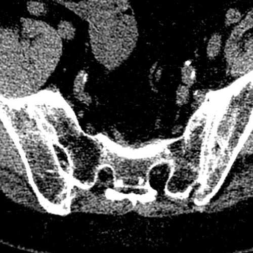 Lumbar L5-S1 Spondy - Spine CTs - embodi3D.com