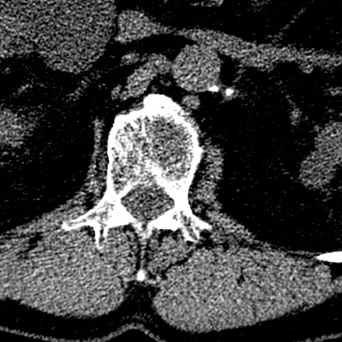 Lumbar L5-S1 Spondy - Spine CTs - embodi3D.com